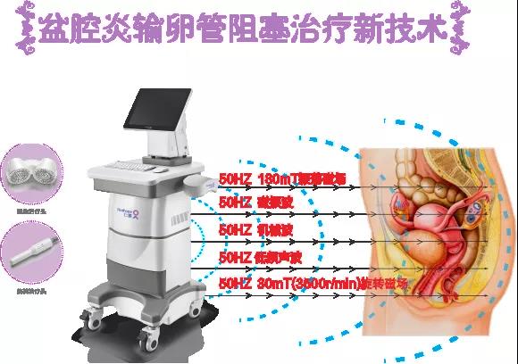 盆腔炎，输卵管阻塞克星来了！vns86com威尼斯城引进永磁旋振治疗仪