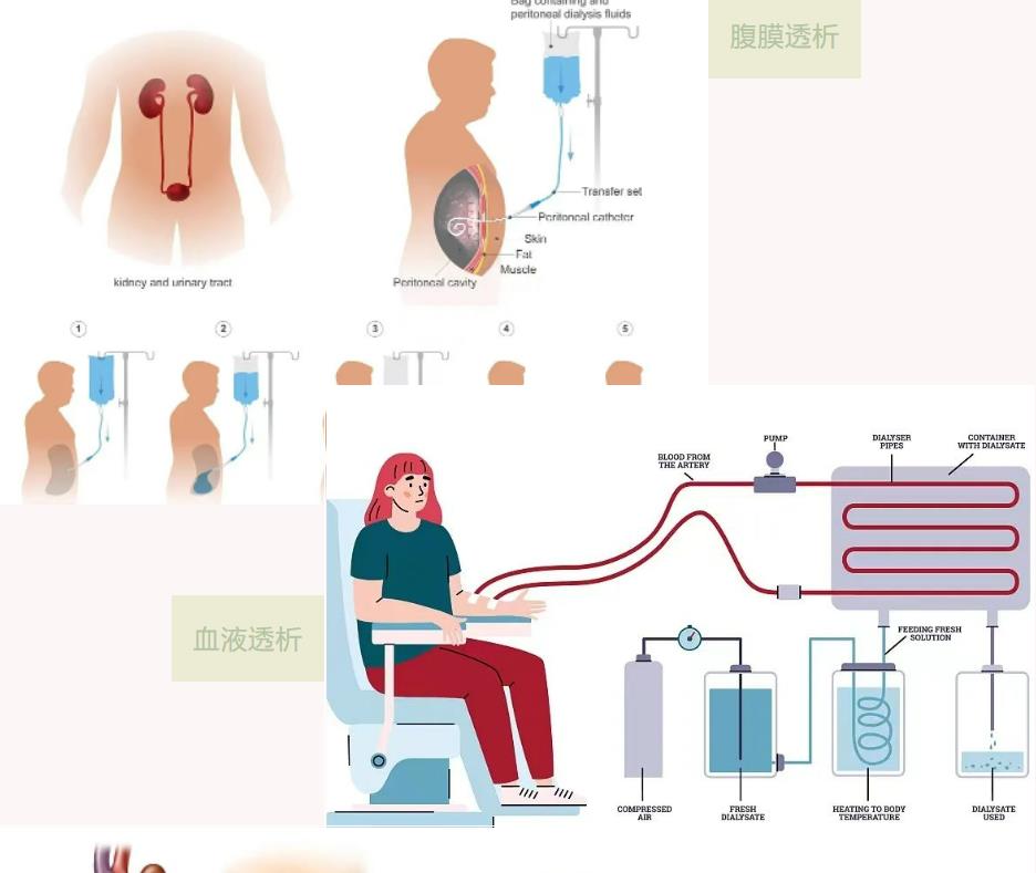 vns86com威尼斯城肾内科成功开展腹腔镜下腹膜透析置管术