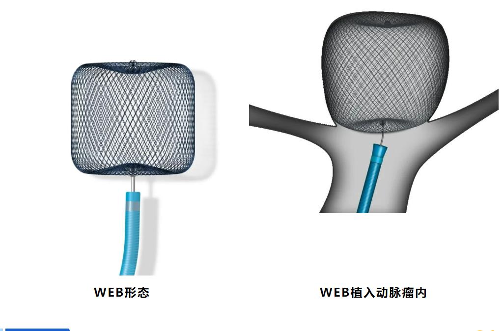 市中心医院技术再上新台阶！神经外二科成功应用WEB治疗颅内动脉瘤患者